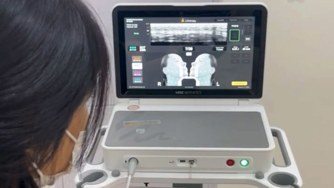 Ultherapy Prime