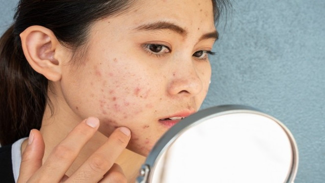 Jerawat Bandel? Coba 6 Bahan Herbal Ini