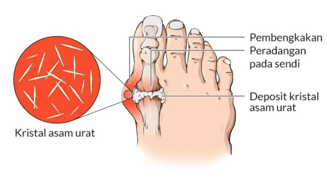 Gejala Awal Asam Urat yang Sering Diabaikan, Apa Saja? Temukan Jawabannya di Sini!, 1. Tahap Asimptomatik (Tanpa Gejala), 2. Tahap Serangan Akut (Gout Attack), 3. Tahap Interkritikal (Masa Antara Serangan), 4. Tahap Kronis (Gout Kronis dengan Tofus), Waspadai Gejala Awal yang Sering Diabaikan, Pencegahan dan Gaya Hidup Sehat, Kesimpulan: Pentingnya Pengenalan Dini