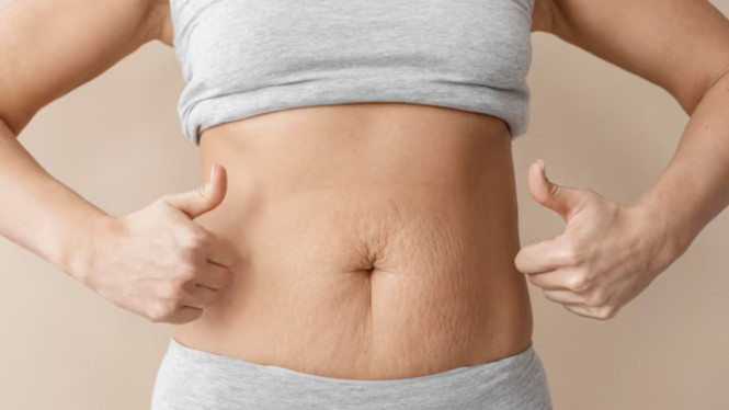 Ilustrasi Stretch Mark, 1. Gunakan Minyak Alami Seperti Minyak Zaitun atau Minyak Kelapa, 2. Oleskan Gel Lidah Buaya Secara Rutin, 3. Eksfoliasi Kulit dengan Scrub Gula Alami, 4. Minum Air yang Cukup dan Jaga Kelembapan Kulit dari Dalam, 5. Konsumsi Makanan yang Kaya Kolagen, 6. Konsisten adalah Kunci