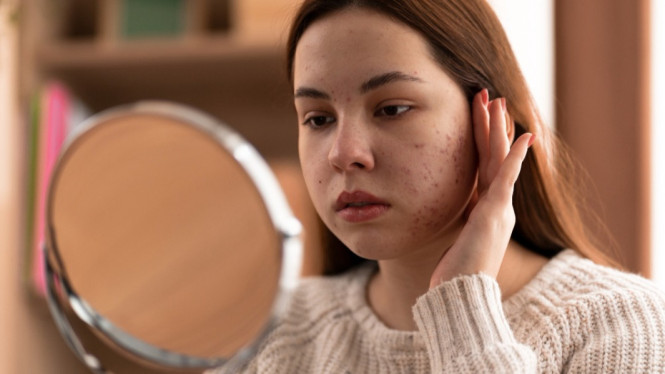Ilustrasi masalah kulit wajah, 1. Uap Wajah untuk Membuka Pori-pori, 2. Scrub Gula dan Madu, 3. Masker Tanah Liat (Bentonite Clay), 4. Perasan Lemon dan Baking Soda, 5. Minyak Kelapa untuk Membersihkan Pori-pori