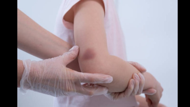 Luka memar, Apa Itu Gangguan Pembekuan Darah?, Penyebab Medis yang Perlu Diwaspadai, Ciri-Ciri Memar yang Patut Diwaspadai, Kapan Harus ke Dokter?, Bisa Dicegah