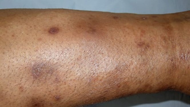 Tanda diabetes di kulit, 1. Bintik pada tulang kering (Shin spots), 2. Area kulit lebih gelap dan terasa seperti beludru, 3. Kulit mengeras dan menebal, 4. Luka terbuka yang sulit sembuh, 5. Muncul bintil-bintil kecil, 6. Benjolan atau bercak kekuningan di sekitar kelopak mata, 7. Daging tumbuh (skin tags), 8. Kumpulan bintil kecil atau bercak timbul, 9. Bercak kuning, kemerahan, cokelat, atau keunguan di kulit