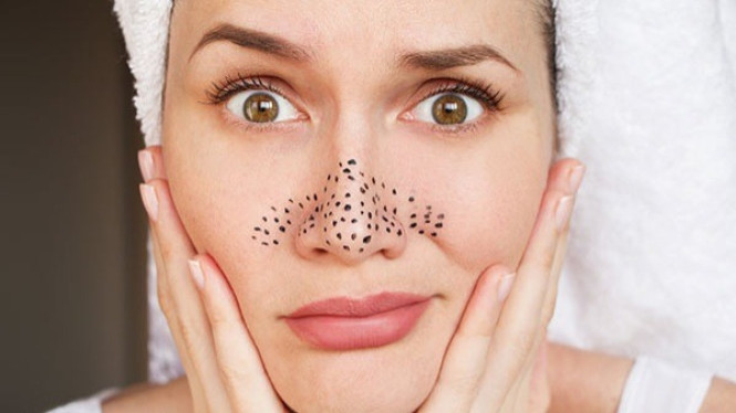 Ilustrasi Komedo, 1. Rutin Membersihkan Wajah secara Gentle, 2. Gunakan Eksfoliasi Secara Teratur, 3. Uap Wajah untuk Membuka Pori-Pori, 4. Gunakan Masker Clay atau Charcoal, 5. Gunakan Skincare Non-Komedogenik