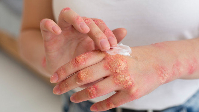gatal psoriasis, Lantas Bagaimana Kaitan antara Gatal dengan Penyakit Autoimun?, Gejala Gatal yang Perlu Diwaspadai, Mengapa Gatal pada Penyakit Autoimun Sulit Hilang?, Dampak Gatal Kronis pada Kesehatan Mental, Kapan Harus ke Dokter?, Cara Mengelola Gatal Akibat Penyakit Autoimun