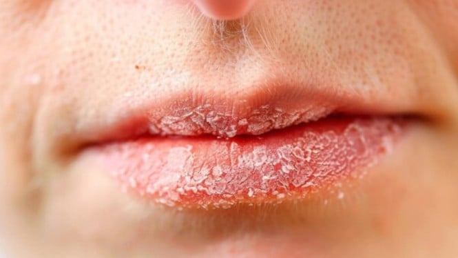 Ilustrasi Bibir Pecah-pecah, 1. Pastikan Kebutuhan Cairan Terpenuhi saat Sahur dan Berbuka, 2. Gunakan Lip Balm dengan Kandungan Melembapkan, 3. Hindari Kebiasaan Menjilat atau Menggigit Bibir, 4. Konsumsi Buah dan Sayur Kaya Air, 5. Gunakan Humidifier