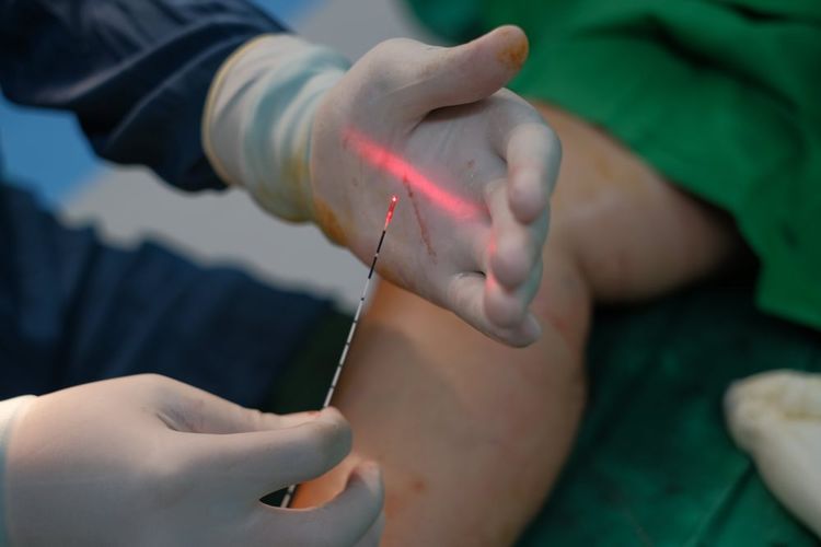 pembuluh darah, spider veins, Cara Modern Mengatasi Kulit Kemerahan karena Pembuluh Darah Kecil