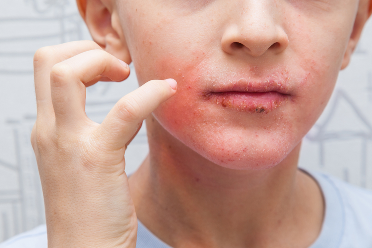 penyebab kulit kering, kesehatan kulit, Penyebab kulit kering, penyebab kulit kering di sekitar mulut, kulit kering di sekitar mulut, kenapa kulit kering mengelupas, Mengapa Kulit di Sekitar Bibir Sering Kering? Ini Penyebab Umumnya, 1. Iritasi dan alergi produk perawatan, 2. Faktor cuaca dan lingkungan, 3. Kebiasaan menjilat bibir, 4. Eksim (dermatitis atopik), 5. Infeksi kulit, 6. Kekurangan nutrisi, 7. Penggunaan skincare yang terlalu kuat