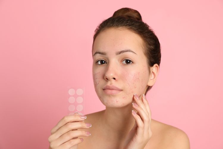 acne patch, pimple patch, dermatolog, apakah pimple patch bisa menghilangkan bekas jerawat, kegunaan acne patch, manfaat acne patch, manfaat pimple patch, pimple patch untuk jerawat, Apakah Pimple Patch Bisa Menghilangkan Jerawat? Ini Jawaban Dokter