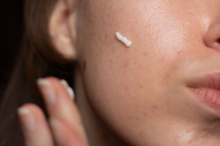 mitos jerawat, pengobatan jerawat, jerawat hormonal, skin barrier itu apa, dermatolog, jerawat pakai bawang putih, apakah jerawat pakai bahan keras, 3 Mitos Jerawat yang Masih Banyak Dipercaya Menurut Dokter