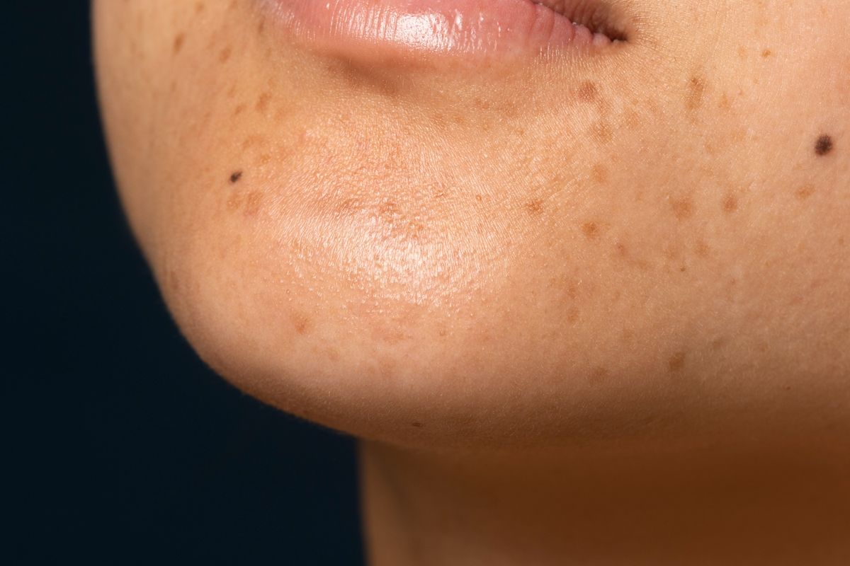 flek hitam, melasma, jenis flek hitam, dark spot, jenis jenis flek hitam, macam macam flek hitam di wajah, jenis flek hitam di wajah, post-inflammatory hyperpigmentation, sunspot, 4 Jenis Flek Hitam di Kulit, Sunspots hingga Melasma, 1. Sunspots (solar lentigines), 2. Post-Inflammatory Hyperpigmentation (PIH), 3. Melasma , 4. Age spots (liver spots)