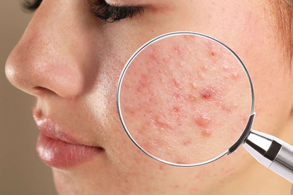 jerawat, bopeng bekas jerawat, penyebab bopeng, bisakah bopeng hilang, dermatolog, siapa yang lebih rentan bopeng, apakah bopeng bisa sembuh, apakah bopeng bekas jerawat bisa hilang, Apakah Bopeng Bekas Jerawat Bisa Hilang? Ini Kata Dokter, Risiko memencet jerawat, Apakah bopeng bisa hilang total?, Siapa yang lebih rentan mengalami bopeng?, Pentingnya mencegah jerawat meradang