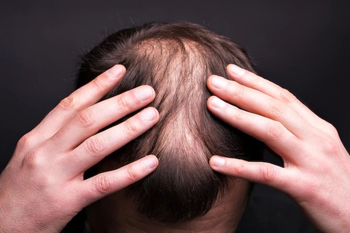transplantasi rambut, Mengapa Transplantasi Rambut Bisa Gagal? Ini Penjelasan Dokter, Maraknya klinik dan standar belum tentu sama, Sterilitas jadi faktor penentu, Pentingnya tenaga medis terlatih, Edukasi pasien jadi kunci pencegahan