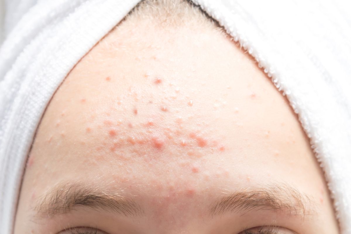 jerawat di dahi, Jerawat Sering Muncul di Dahi, Ini Penyebab dan Cara Mengatasinya, Penyebab jerawat di dahi, Produk rambut ikut memicu jerawat,  ilustrasi jerawat, cara menghilangkan jerawat secara alami., Jenis jerawat di dahi beragam, Cara mengatasi jerawat di dahi, Pencegahan jerawat di dahi
