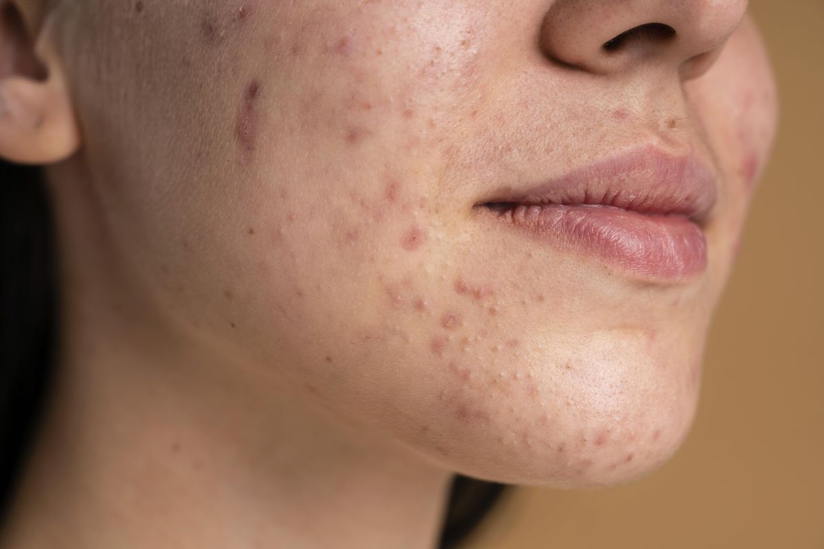 jerawat, kulit sensitif, skin barrier, Eva Mulia Clinic, skincare, Cara Tepat Atasi Jerawat pada Kulit Sensitif Tanpa Takut Iritasi