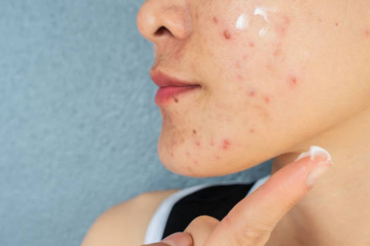 stres, jerawat stres, stres menyebabkan jerawat, cara mengatasi jerawat stress, mengatasi jerawat stres, jerawat karena stres, stres jerawat, 7 Cara Mengatasi Jerawat Stres Menurut Pakar, Tak Hanya Skincare, 1. Gunakan produk topikal dengan bahan aktif, 2. Pilih pelembab yang non-komedogenik, 3. Coba pimple patch , 4. Konsultasi dokter untuk jerawat yang membandel, 5. Pertimbangkan perawatan di klinik, 6. Perbaiki pola hidup untuk mengurangi stres, 7. Pertimbangkan suplemen pendukung