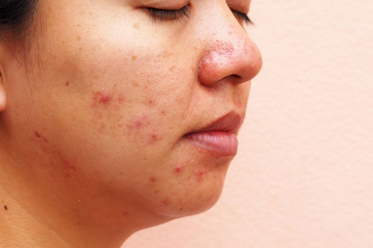 mitos jerawat, pengobatan jerawat, jerawat hormonal, skin barrier itu apa, dermatolog, jerawat pakai bawang putih, apakah jerawat pakai bahan keras, 3 Mitos Jerawat yang Masih Banyak Dipercaya Menurut Dokter