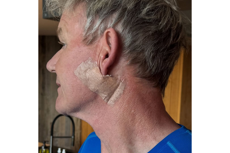 kanker kulit, Gordon Ramsay, kanker kulit wajah, karsinoma sel basal, gordon ramsay kanker kulit, gordon ramsay skin cancer, basal cell carcinoma, Gordon Ramsay Kena Kanker Kulit Karsinoma Sel Basal, Apa Itu?, Gordon Ramsay mengidap kanker kulit karsinoma sel basal, Apakah kanker kulit karsinoma sel basal berbahaya?, Tanda terkena kanker kulit karsinoma sel basal, Cara mencegah kanker kulit karsinoma sel basal