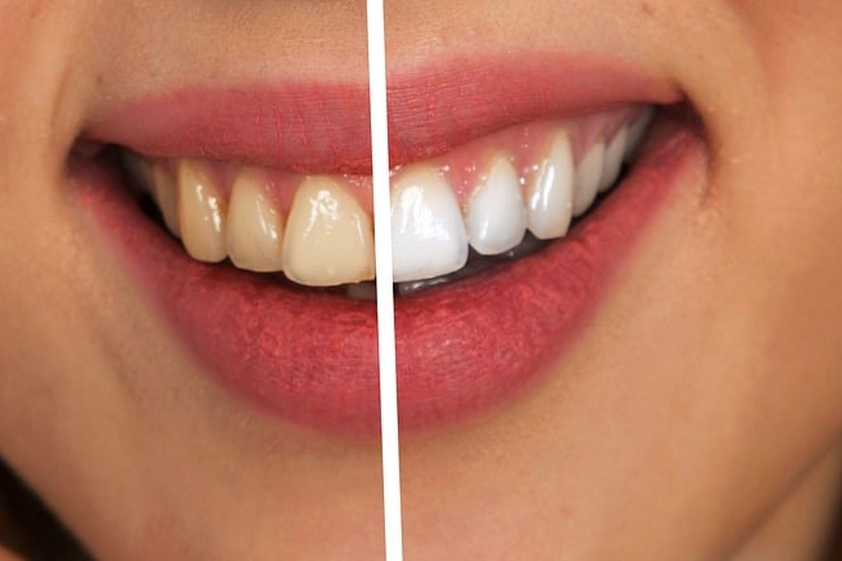 Whitening strips, whitening strips, Apakah strip pemutih benar-benar dapat memutihkan gigi, Berapa lama strip pemutih bertahan, Apakah strip pemutih gigi aman, teeth whitening strips, white strips, whitening strips untuk gigi, Whitening Strips Bisa Memutihkan Gigi? Ini Penjelasan Dokter