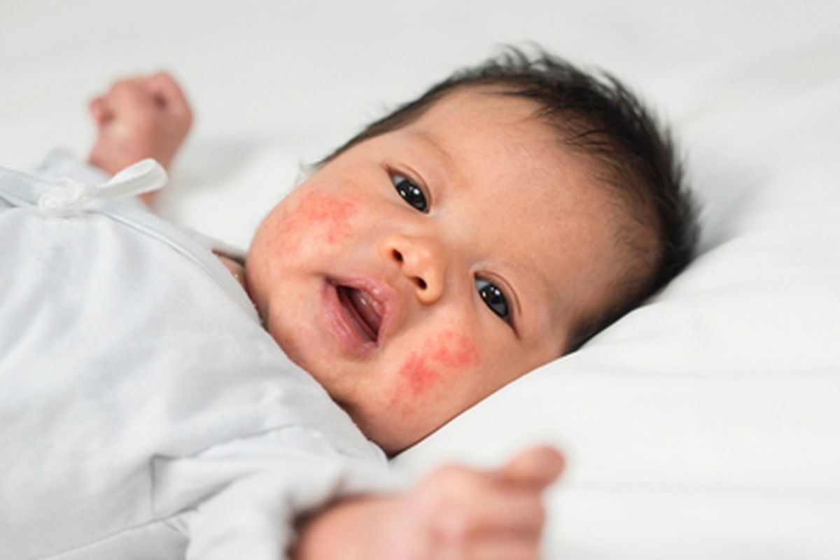 Mustela, dermatitis atopik, Dampak Eksim Tak Cuma Ganggu Kesehatan Kulit Anak