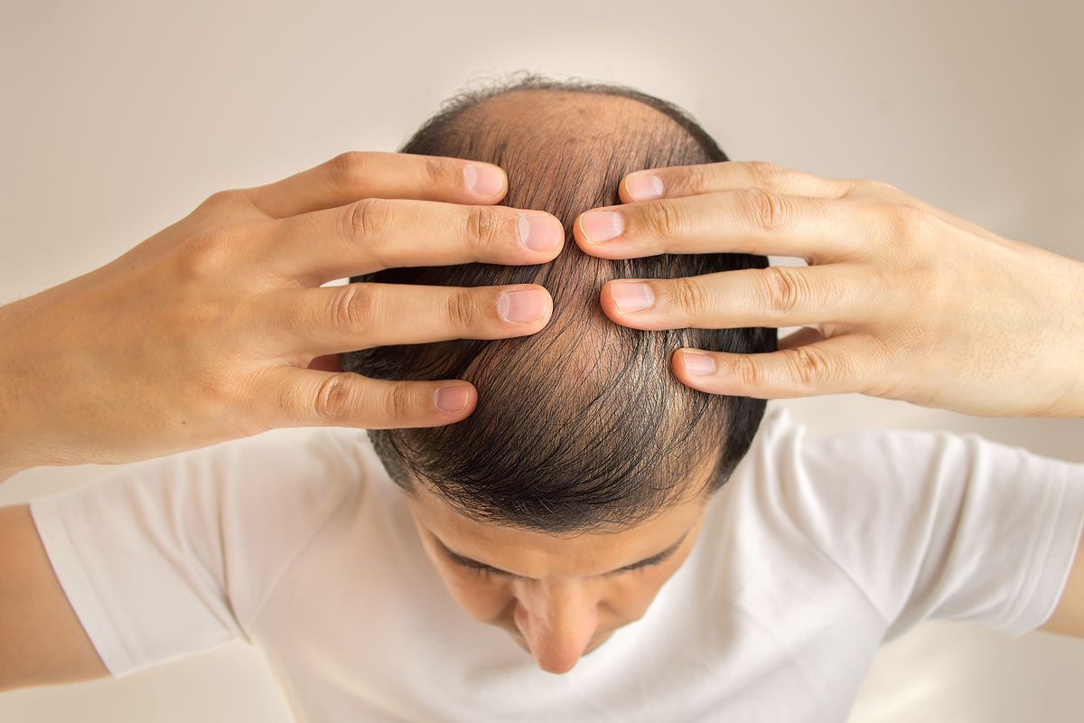 kebotakan pada pria, Beda Rambut Rontok dan Kebotakan pada Pria