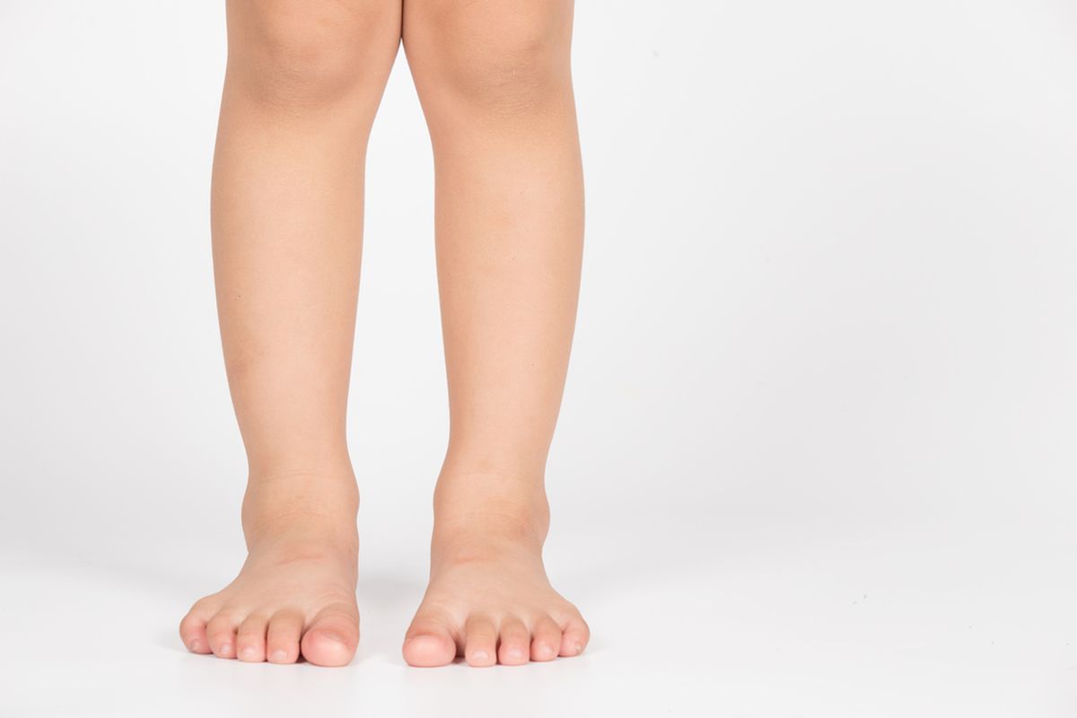 kaki X dan O, Bentuk Kaki X dan O pada Anak, Kapan Orangtua Harus Waspada?