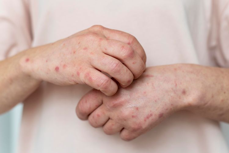 cacar monyet di riau, kasus monkeypox Indonesia 2025, santri meninggal cacar monyet, gejala cacar monyet pada manusia, cacar monyet Kepulauan Meranti, dugaan monkeypox di pesantren, kematian akibat cacar monyet Riau, update kasus cacar monyet hari ini, 1 Orang di Riau Meninggal Diduga Cacar Monyet, 3 Lainnya Suspek, Satu meninggal, tiga lainnya suspek, Gejala mirip monkeypox, masil lab masih ditunggu, Bupati Meranti instruksikan penanganan cepat, Pemda imbau warga waspada, tidak panik
