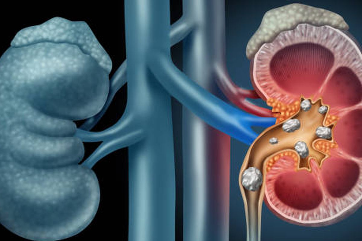Batu ginjal, batu ginjal, Batu Ginjal, Waspadai Jenis Makanan Pemicu Batu Ginjal, Tips Pencegahan Batu Ginjal, 5 Jenis Makanan yang Dapat Sebabkan Batu Ginjal, Ini Kata Dokter