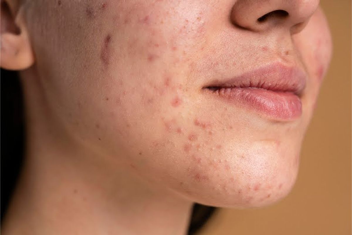jerawat, putus cinta, breakout, Mengapa Putus Cinta Bisa Bikin Kulit Breakout dan Berjerawat?, Stres meningkat setelah putus cinta, Kurang tidur membuat kulit lebih sulit memperbaiki diri, Rutinitas skincare sering terbengkalai saat patah hati, Mengelola emosi dapat membantu kulit lebih cepat pulih