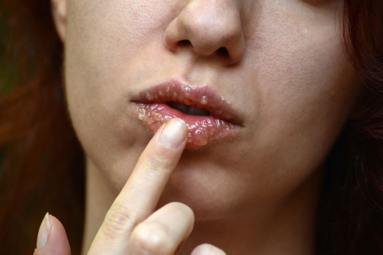 bibir kering, pelembap bibir, bibir pecah pecah, tips mengatasi bibir kering, cara melembapkan bibir, penyebab bibir pecah, cara merawat bibir, 2 Cara Mengatasi Bibir Kering dan Pecah-pecah agar Tetap Lembap