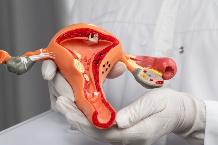 Kanker ovarium, kanker ovarium, faktor risiko kanker ovarium, gejala kanker ovarium, gejala kanker ovarium stadium awal, dokter obstetri dan ginekologi, ovarian cancer adalah, apa itu kanker ovarium, Siapa yang paling berisiko mengembangkan kanker ovarium, 5 Faktor Risiko Kanker Ovarium yang Harus Diwaspadai Perempuan Menurut Dokter, 1. Menstruasi dini dan menopause terlambat, 2. Tidak pernah hamil, 3. Riwayat kanker dalam keluarga, 4. Obesitas, 5. Usia di atas 50 tahun