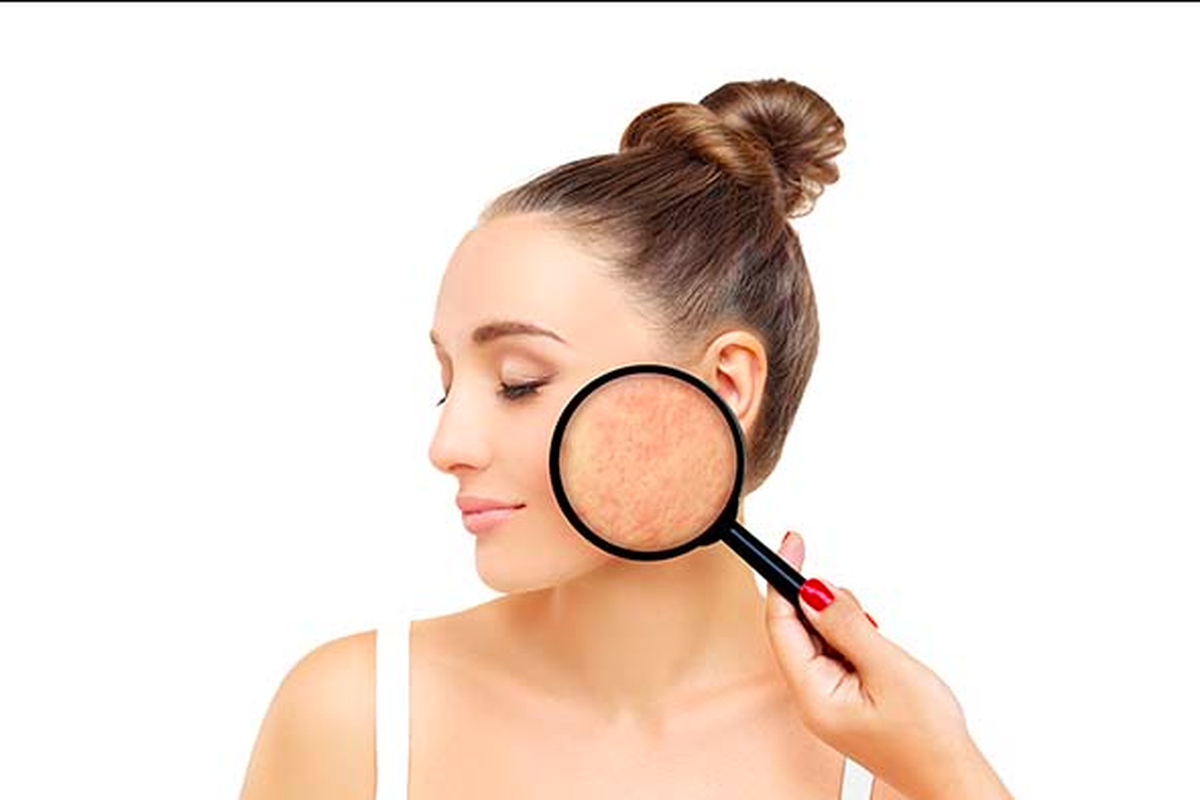Kemerahan akibat jerawat, kemerahan akibat jerawat, cara menghilangkan kemerahan bekas jerawat, tips meredakan kemerahan akibat jerawat, cara mengatasi kemerahan pada wajah, jerawat kemerahan, 6 Cara Mengurangi Kemerahan Akibat Jerawat, Pakai Sunscreen Setiap Hari, 1. Gunakan pembersih wajah yang lembut, 2. Terapkan bahan antiinflamasi, 3. Hindari menggosok atau memencer jerawat, 4. Gunakan sunscreen setiap hari, 5. Pertimbangkan perawaran profesional, 6. Jaga pola hidup sehat