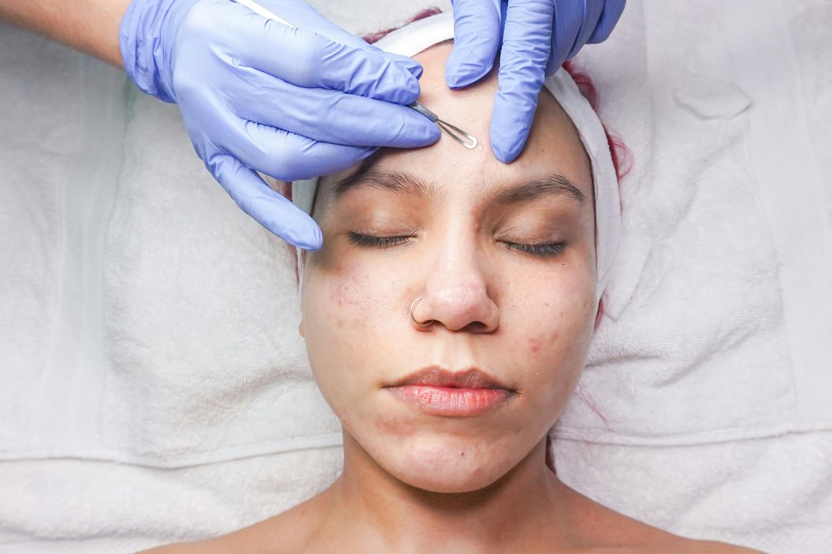 klinik kecantikan, treatment jerawat, Klinik kecantikan, Alasan Harus Treatment Jerawat di Klinik Kecantikan, alasan wajib ke klinik kecantikan, mengapa treatment jerawat di klinik kecantikan penting, 3 Alasan Perlu Mengobati Jerawat di Klinik Kecantikan