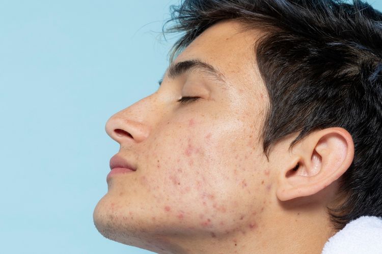 stres, jerawat stres, stres menyebabkan jerawat, cara mengatasi jerawat stress, mengatasi jerawat stres, jerawat karena stres, stres jerawat, 7 Cara Mengatasi Jerawat Stres Menurut Pakar, Tak Hanya Skincare, 1. Gunakan produk topikal dengan bahan aktif, 2. Pilih pelembab yang non-komedogenik, 3. Coba pimple patch , 4. Konsultasi dokter untuk jerawat yang membandel, 5. Pertimbangkan perawatan di klinik, 6. Perbaiki pola hidup untuk mengurangi stres, 7. Pertimbangkan suplemen pendukung