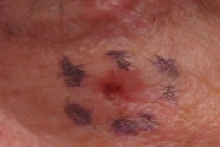 kanker kulit, Gordon Ramsay, kanker kulit wajah, karsinoma sel basal, gordon ramsay kanker kulit, gordon ramsay skin cancer, basal cell carcinoma, Gordon Ramsay Kena Kanker Kulit Karsinoma Sel Basal, Apa Itu?, Gordon Ramsay mengidap kanker kulit karsinoma sel basal, Apakah kanker kulit karsinoma sel basal berbahaya?, Tanda terkena kanker kulit karsinoma sel basal, Cara mencegah kanker kulit karsinoma sel basal