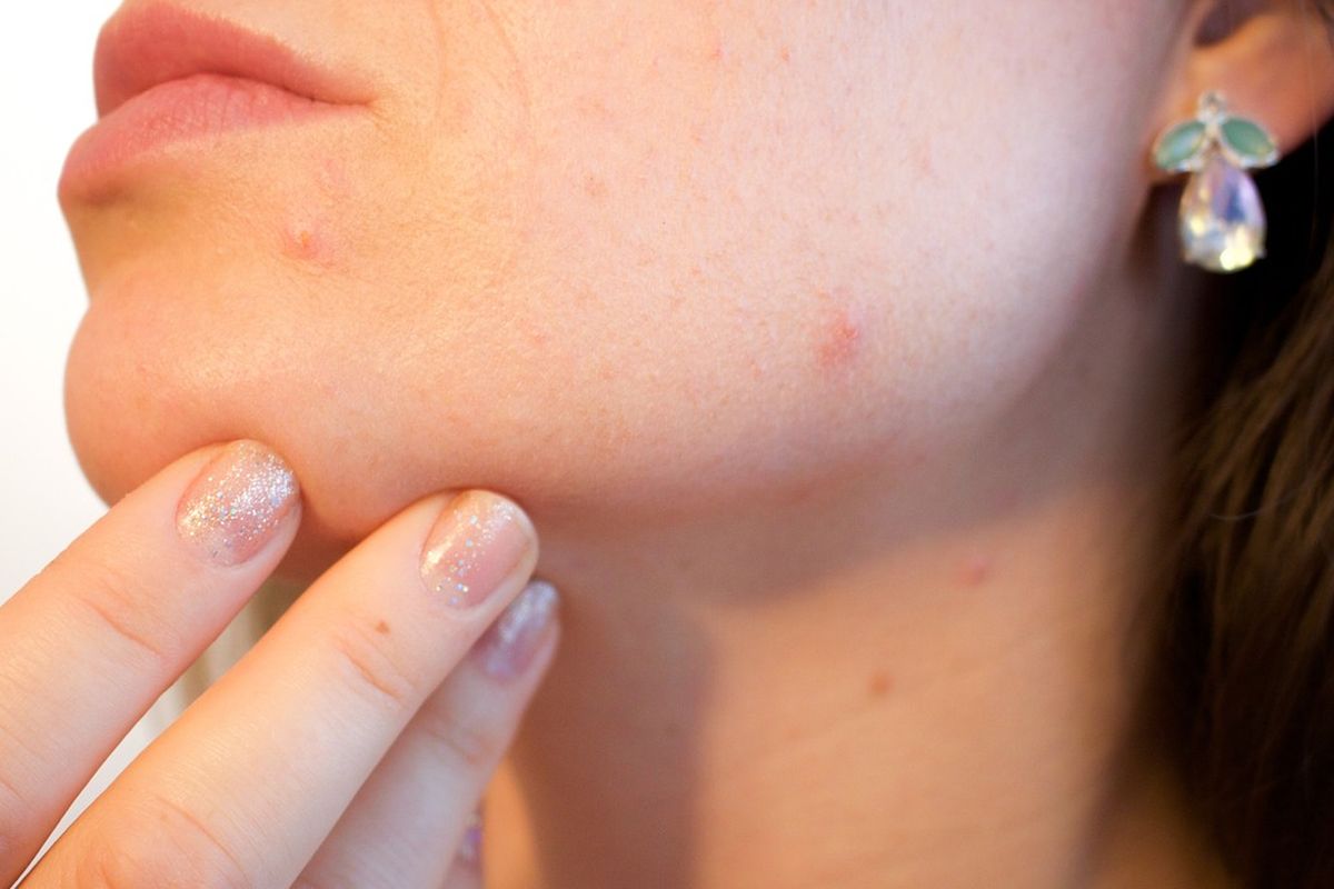 cara mencegah jerawat, basic skincare, dermatolog, tips skincare untuk kulit berjerawat, tips skincare yang benar, tips menjaga kulit yang berjerawat, tahapan skincare kulit berjerawat, bagaimana cara mencegah jerawat agar tidak muncul lagi, pencetus jerawat, basic skincare untuk jerawat, Cara Mencegah Jerawat agar Tidak Muncul Lagi, Tak Cuma Skincare, 1. Kenali pencetus jerawat, 2. Jaga kebersihan wajah dan lingkungan, 3. Hindari kebiasaan memencet jerawat, 4. Pola hidup sehat sebagai penunjang
