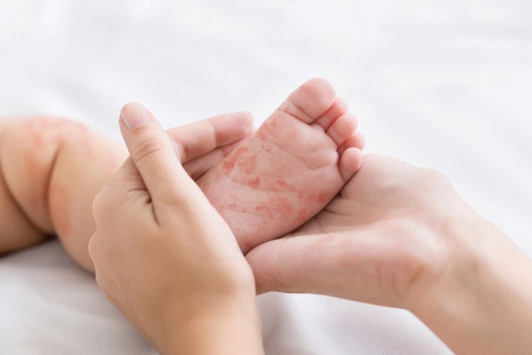 campak, gejala campak, penyakit campak, Campak pada anak, kasus campak, gejala campak pada orang dewasa, gejala campak pada anak, klb campak di indonesia, campak apakah menular, Kasus Campak Tinggi di Sumenep, Kenali Gejala dan Kelompok yang Rentan Terinfeksi, Apa saja gejala campak?, Siapa saja yang berisiko terkena campak?, Hati-hati dengan komplikasi akibat campak, Tingginya kasus campak di Sumenep