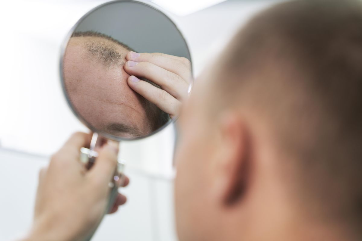 kerontokan rambut, hormon androgen, androgenetik alopesia, androgenetik alopecia, Mengenal Androgenetik Alopesia, Penyebab Botak pada Pria dan Wanita