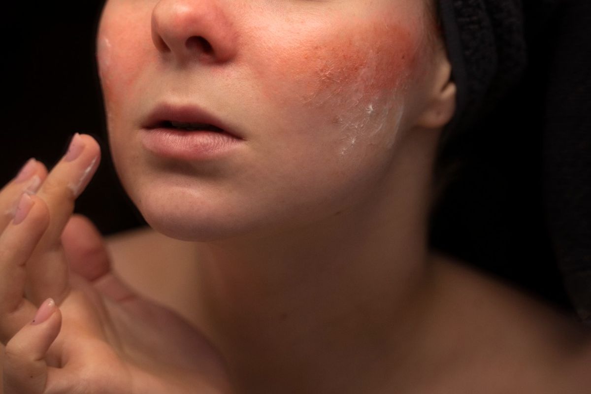 rosacea, jerawat, Rosacea, Jerawat, rosacea adalah, cara mengobati rosacea, rosacea itu apa, Rosacea kambuh saat berjerawat, Rosacea dan jerawat, Rosacea Kambuh Saat Sedang Berjerawat, Mana yang Harus Diobati Lebih Dulu?