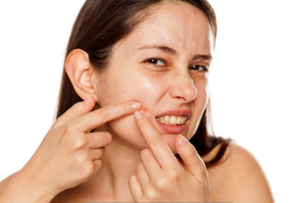 Bopeng, bekas jerawat, bopeng, acne scar, Bopeng bekas jerawat, bopeng bekas jerawat, treatment, apakah bopeng bisa hilang, bisakah bopeng bekas jerawat hilang, apakah bopeng bisa hilang tanpa treatment, bisakah bopeng hilang, Bopeng Bekas Jerawat, Mungkinkah Hilang? Simak Penjelasan Dokter