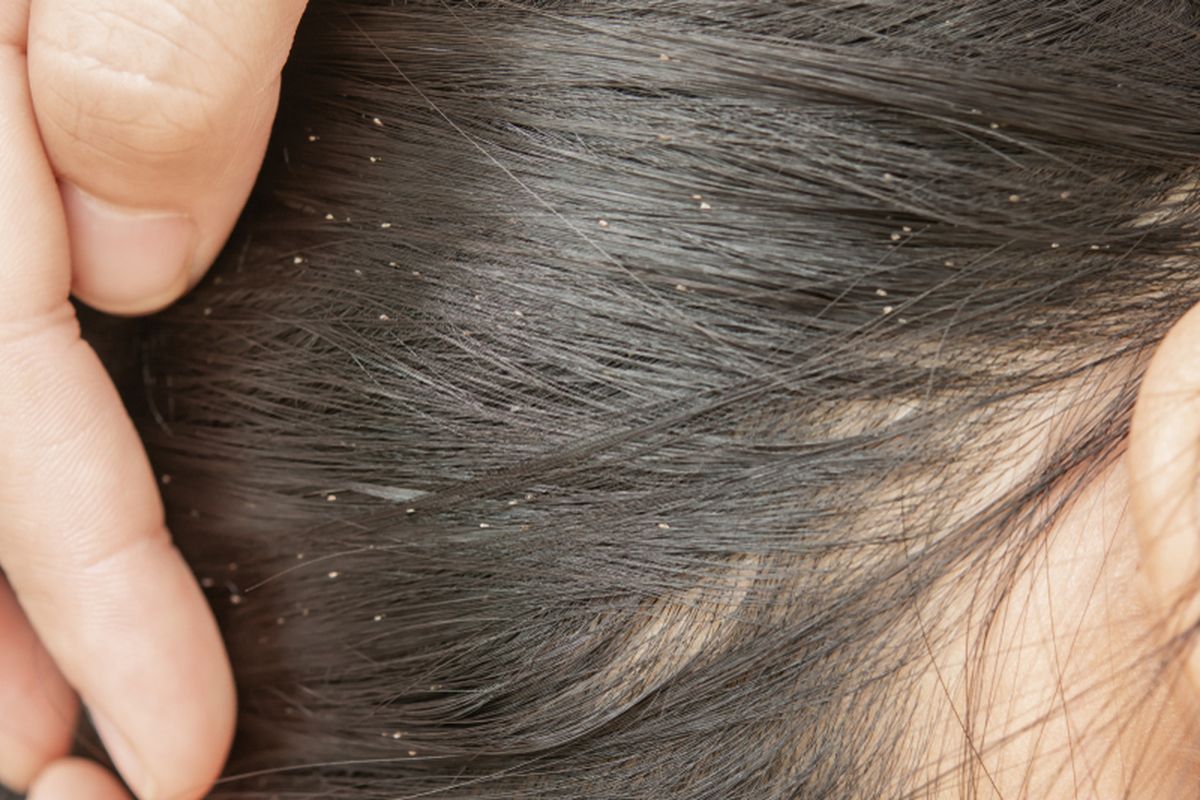anak-anak, Kutu Kepala, kutu kepala, Perawatan Rambut, Anak-anak, perawatan rambut, Anak-Anak, penularan kutu, Kenapa Anak-anak Lebih Rentan Terkena Kutu Rambut?