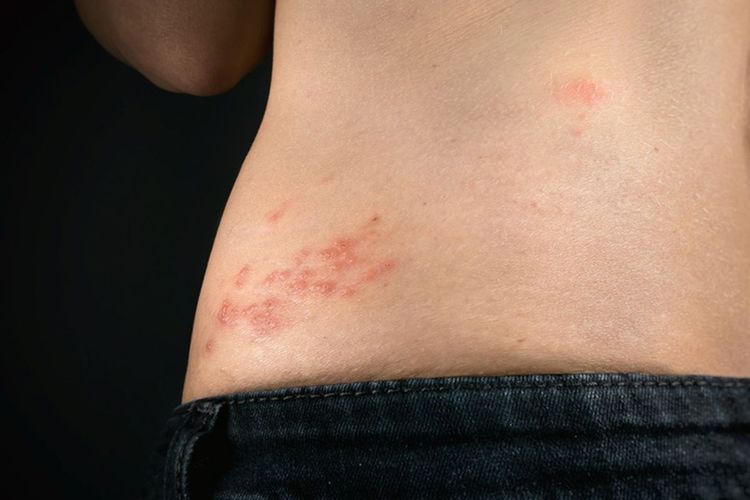 Maia Estianty, cacar api, herpes zoster, penyakit cacar api, Cacar Api, lansia, maia estianty cegah cacar api, maia estanty lindungi keluarga dari cacar api, bahaya cacar api, Maia Estianty Ajak Keluarga Lindungi Diri dari Cacar Api dengan Vaksinasi dan Hidup Sehat