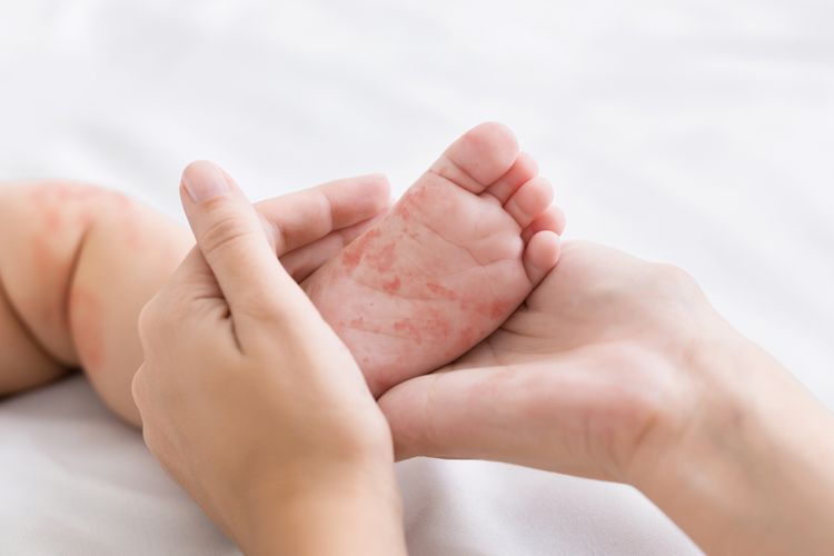 campak, KLB Campak, gejala campak, penyakit menular, penyakit campak, penyakit campak berbahaya, gejala campak pada anak, klb campak di sumenep, penyakit campak pada anak, Gejala Campak dan Penyebabnya, Penyakit Menular yang Bisa Dicegah Vaksin, Gejala Campak pada Anak, Penyebab dan Faktor Risiko Campak, Cara Penularan Campak, Pengobatan Campak, Cara Mencegah Campak