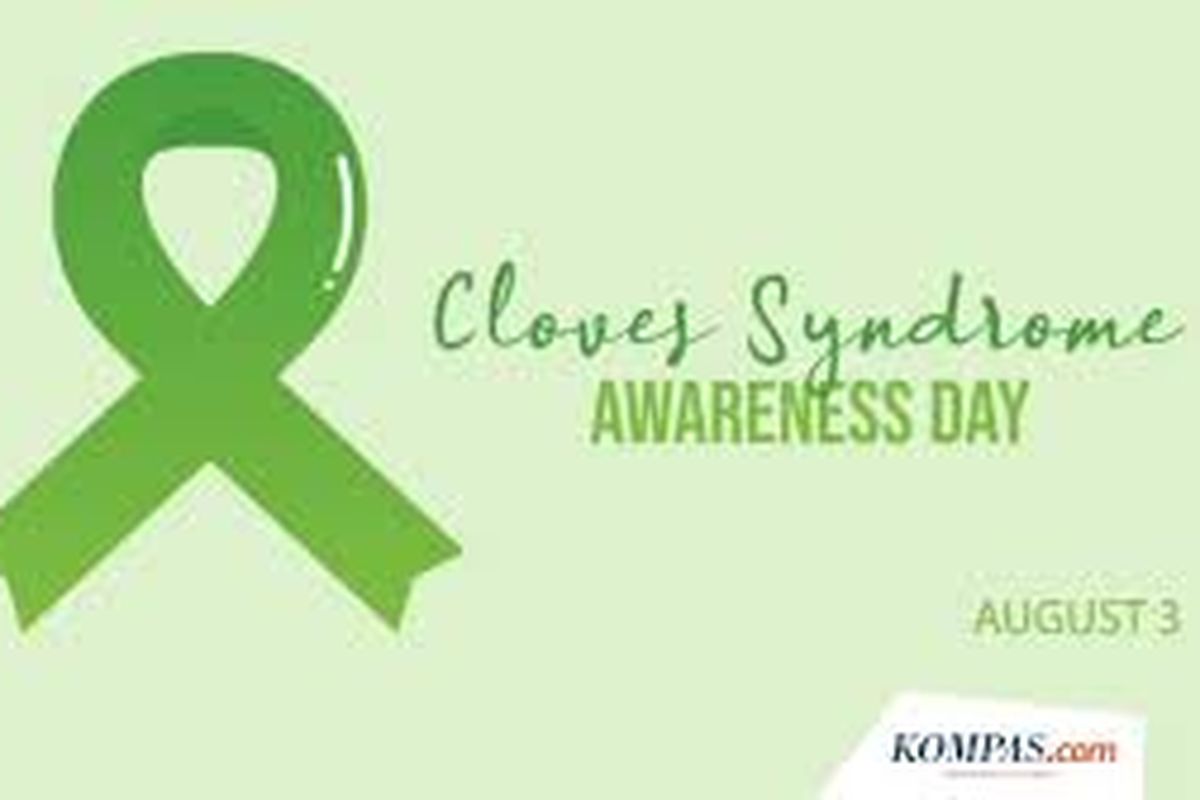 3 Agustus memperingati hari apa, Sindrom Cloves, sindrom cloves, 3 agustus memperingati hari apa, tanggal 3 agustus memperingati apa, tanggal 3 agustus hari apa, 3 Agustus Memperingati Hari Apa? Ada Peringatan Sindrom Cloves