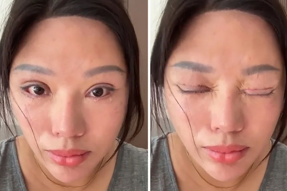 Operasi Kelopak Mata Gagal, Wanita Ini Tak Bisa Tidur Terpejam