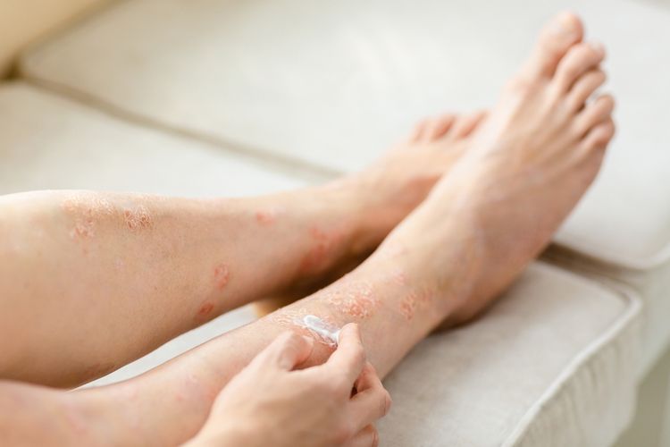 dermatitis atopik, eksim, Atopic march, Mustela, Cara Mencegah Eksim pada Bayi Berkembang Jadi Bentuk Alergi Lain