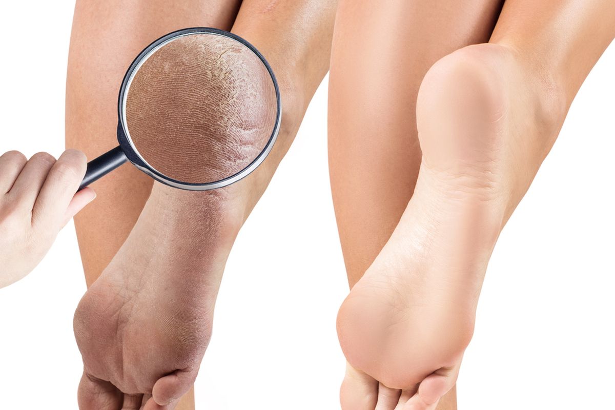 kaki kering, kaki kering pecah-pecah, kaki kering dan pecah-pecah, 7 Cara Alami Mengatasi Kaki Kering dan Pecah-pecah yang Ampuh, Rendam kaki dalam air hangat, Minyak kelapa, Masker pisang dan alpukat, Menggosok dengan batu atau loofah