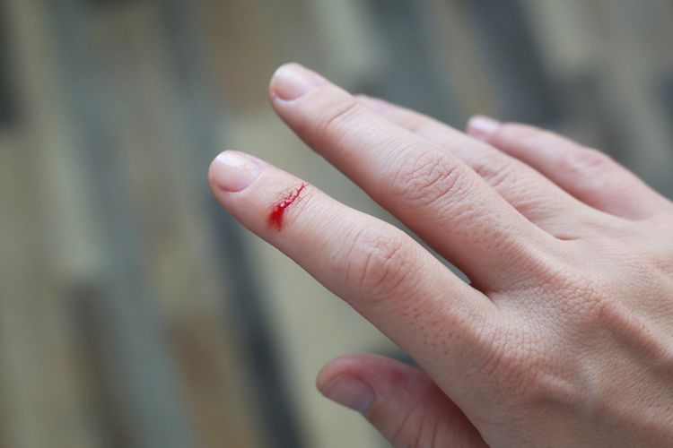 keropeng, luka, koreng, luka di kulit, cara menyembuhkan luka dengan cepat, keropeng luka, tanda luka sembuh, tanda luka semakin sembuh, menangani keropeng, menangani luka, Keropeng Bisa Hambat Penyembuhan Luka, Ini Kata Dokter, Mengapa keropeng bisa menghambat penyembuhan luka?, Cara aman menangani luka keropeng di rumah, Luka yang lembap bisa lebih cepat sembuh, Konsultasikan ke dokter jika luka tak kunjung sembuh