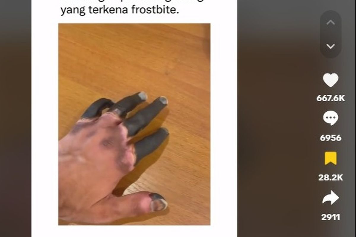 frostbite, Frostbite, radang dingin, aoa itu frostbite, Viral Video Pendaki Gunung Alami Amputasi karena Frostbite, Apa Itu?