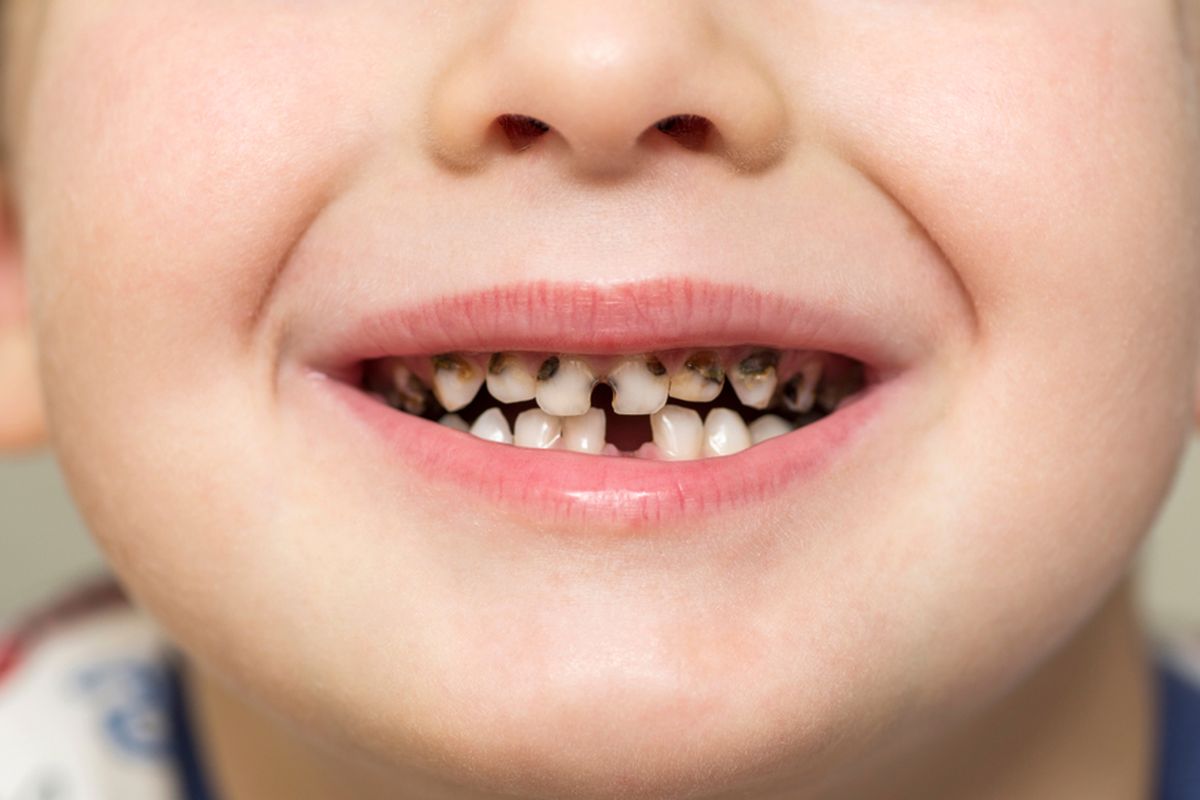 Nursing bottle caries, baby bottle tooth decay, nursing bottle caries, karies gigi, karies gigi pada anak, karies pada gigi anak, karies gigi anak, nursing bottle carries adalah, apa itu nursing bottle carries, Apa Itu Nursing Bottle Caries, yang Bisa Terjadi pada Gigi Anak?